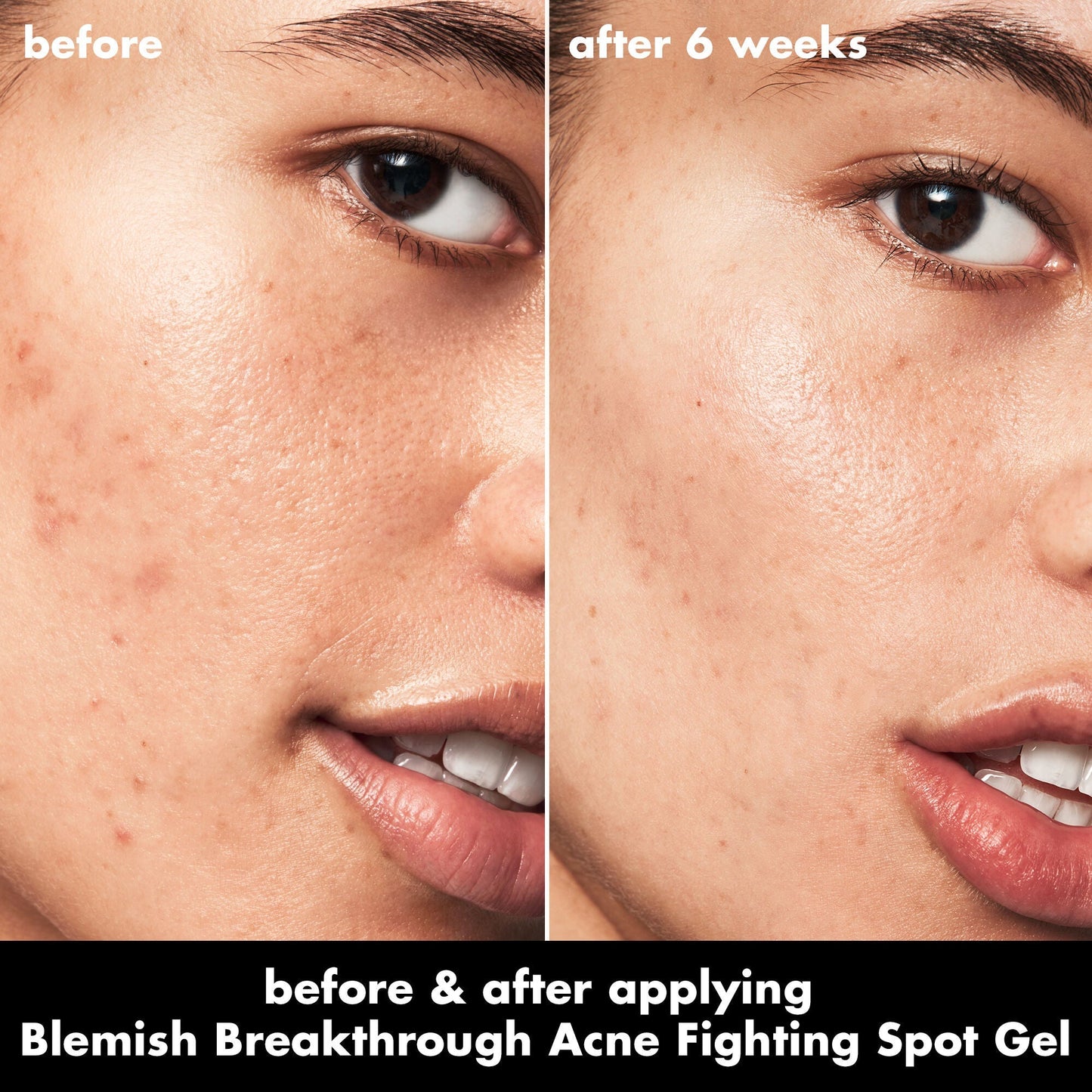 blemish-breakthrough-acne-fighting-spot-gel-o3 0326_EDU_BB_SpotGel_BA_ISABELLA.jpg