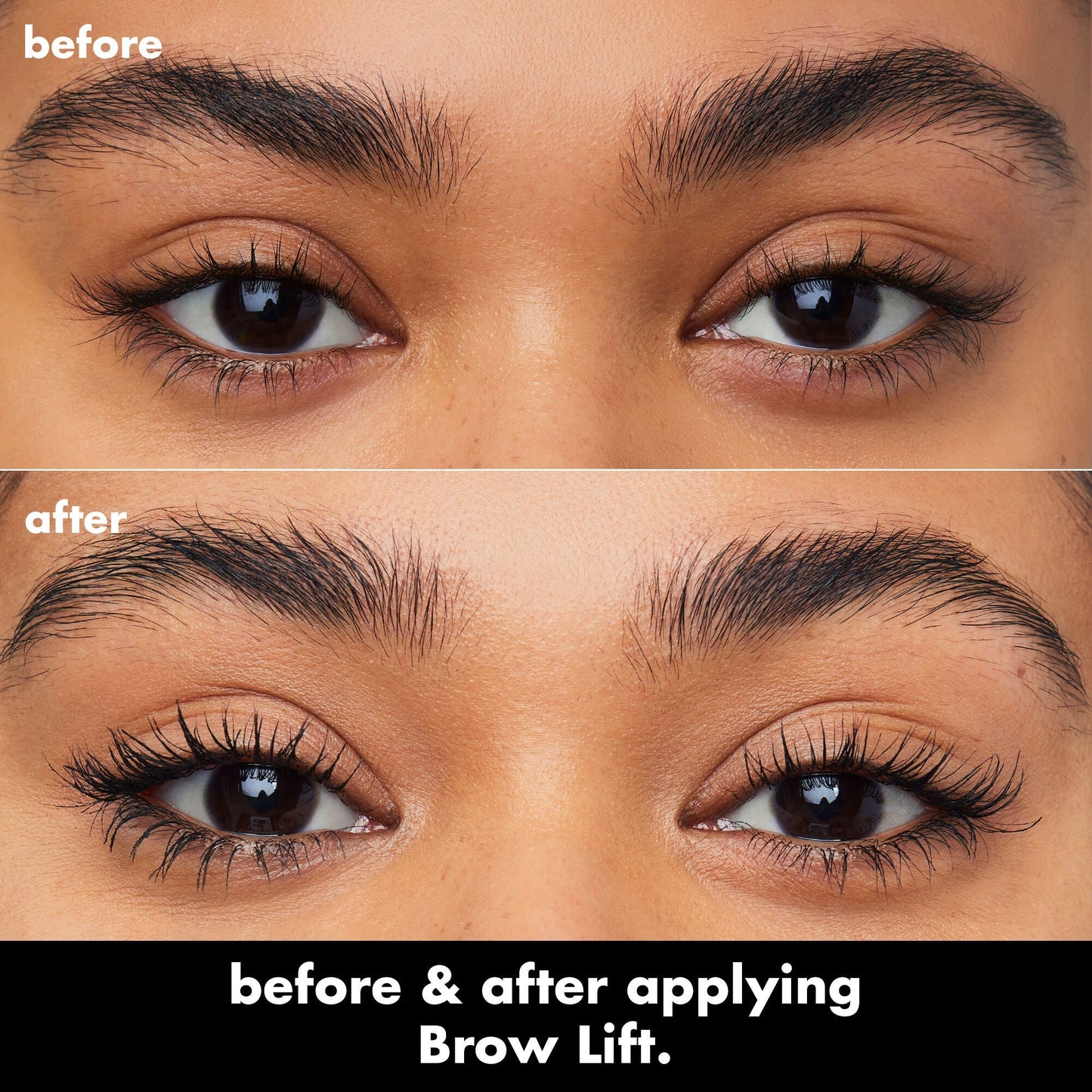 brow-lift-d8 0326_EDU_BrowLift_BA.jpg
