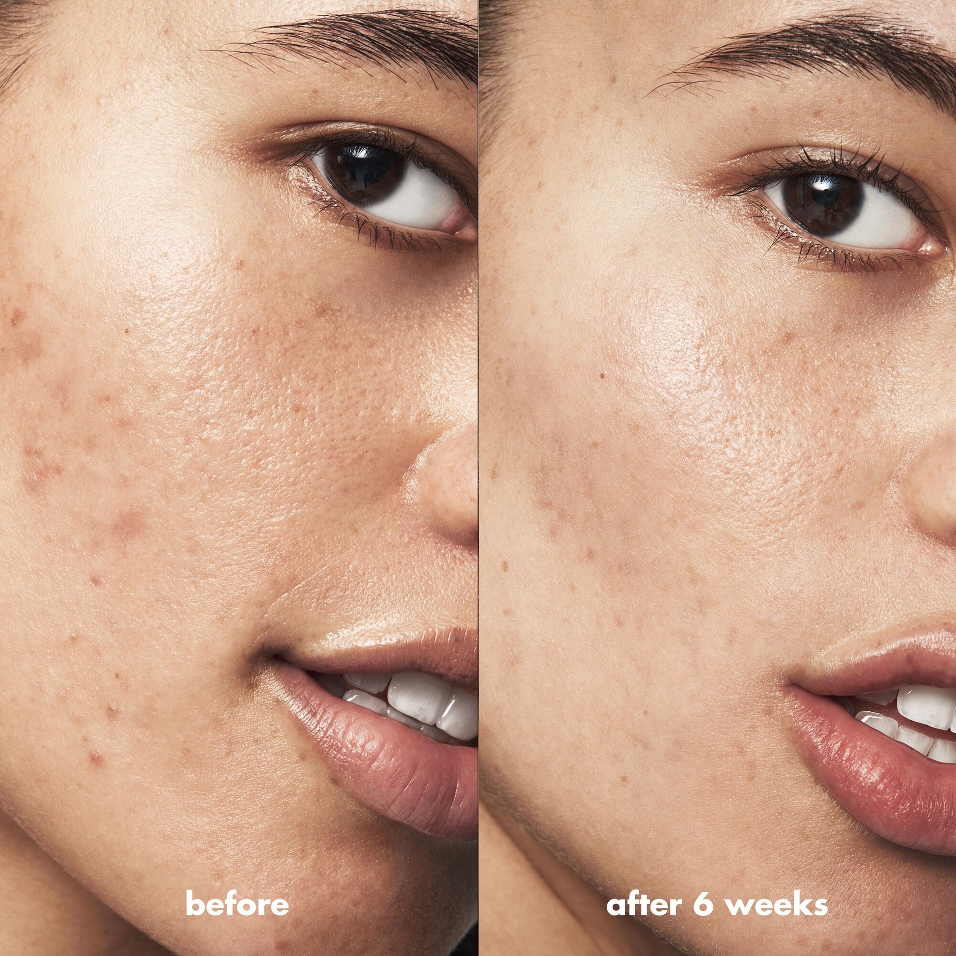 blemish-breakthrough-acne-calming-water-cream-e5 Acne_PDP_Isabella_Before_After_84ce713a-22d2-4bb9-aad7-445c7b27b1c9.jpg