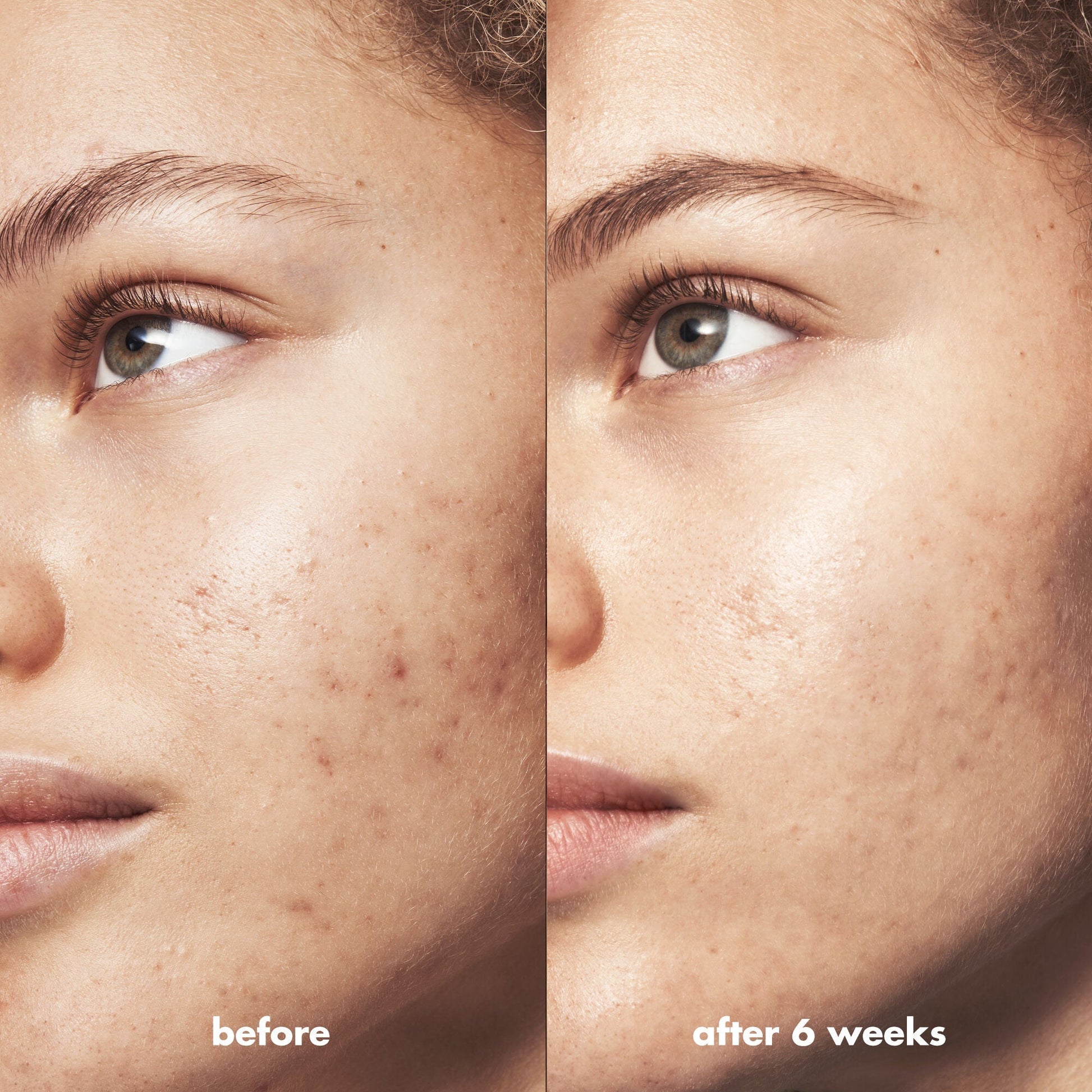 blemish-breakthrough-triple-acid-resurfacing-serum-x2 Acne_PDP_Marley_Before_After_1a95cac5-0af6-43b6-a936-d0bacbdec0bf.jpg